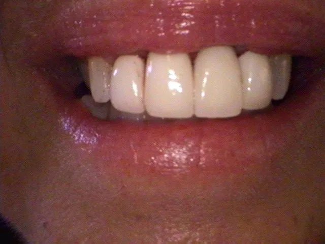 Dental implants after