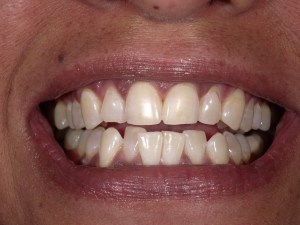 Zoom teeth whitening after