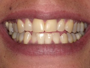 Zoom teeth whitening before