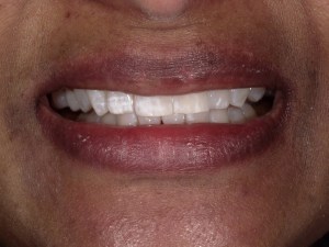 Zoom teeth whitening after