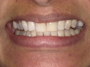 Zoom teeth whitening before