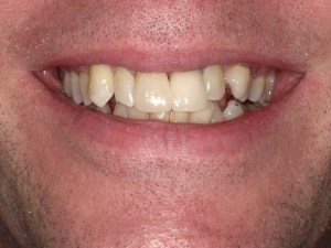 Restored smile: uniform shape, natural shade, and improved occlusion — post-dental crowns