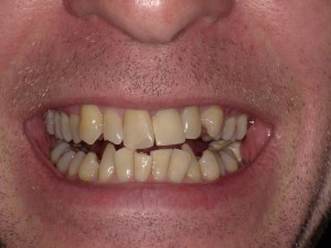 Upper anterior teeth with discoloration, chipping, and uneven alignment — pre-crown treatment