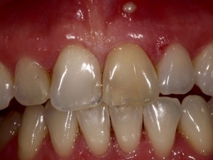 Anterior teeth with uneven shade and texture — one tooth appears restored (possibly crown or veneer) amid natural dentition