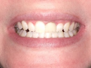 Zoom teeth whitening after