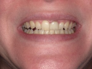 Zoom teeth whitening before