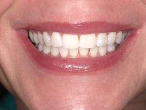 Zoom teeth whitening after