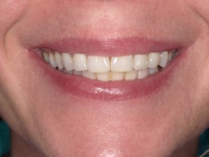 Zoom teeth whitening before