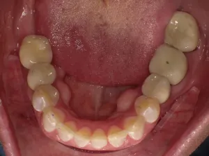 straight, symmetrical tooth