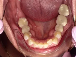 crowded, rotated teeth