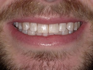 Zoom teeth whitening after