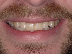 Zoom teeth whitening before