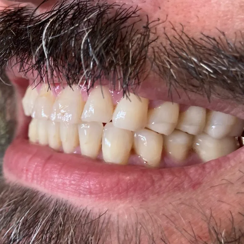 Aligned, evenly spaced teeth with improved bite — post-Invisalign treatment.