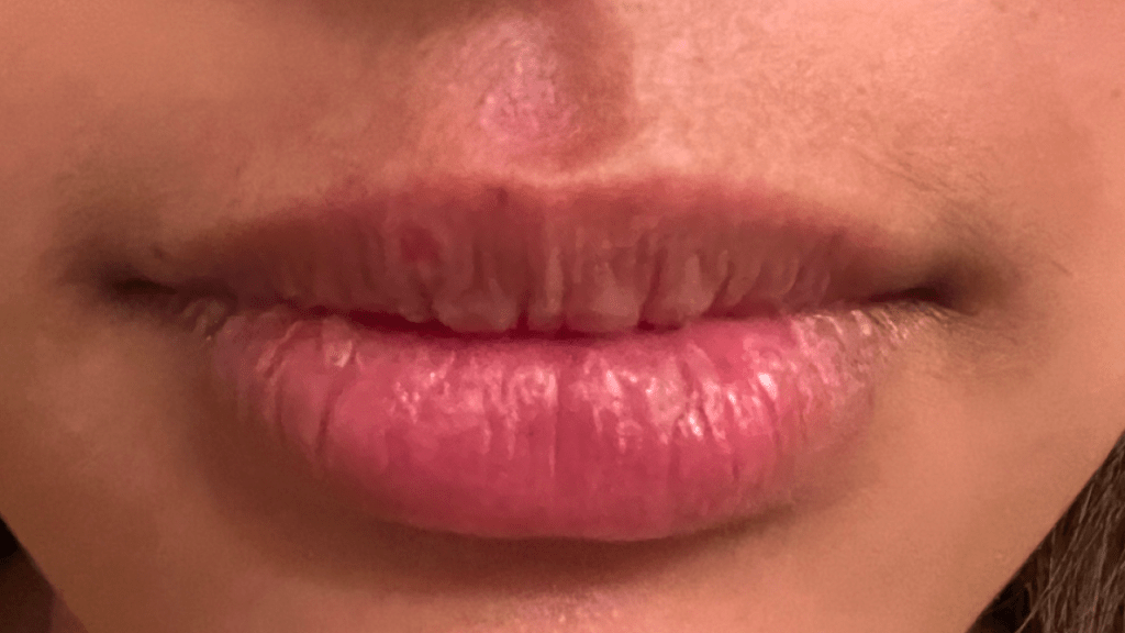 Three Days After Cold Sore Laser Treatment