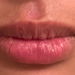Three Days After Cold Sore Laser Treatment