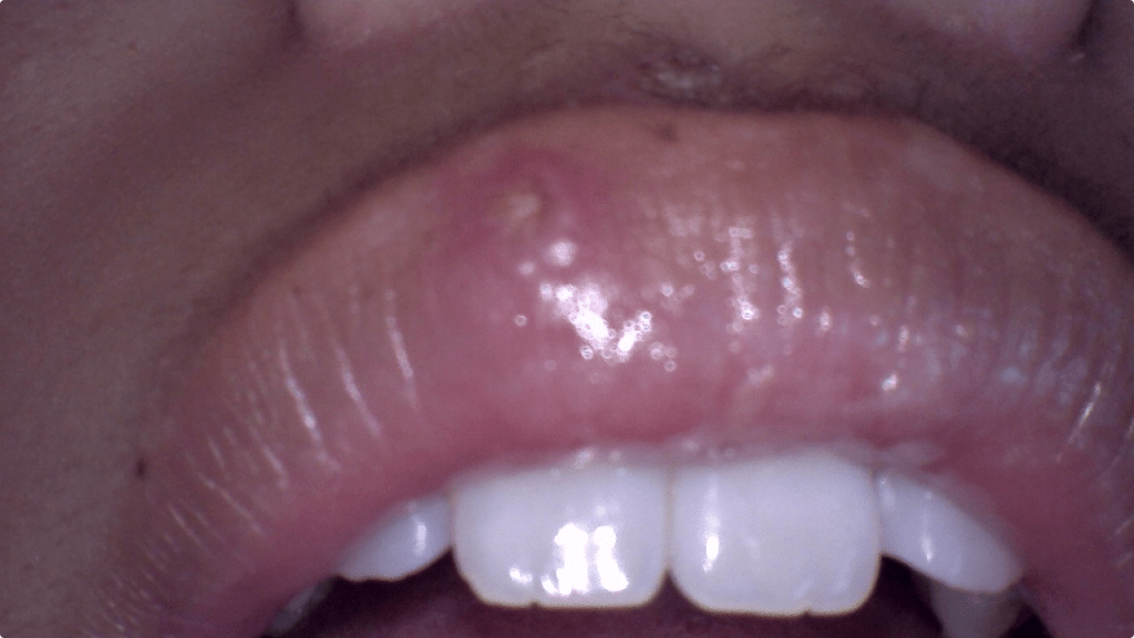 Before Cold Sore Laser Treatment in Sunnyvale