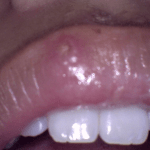 Before Cold Sore Laser Treatment in Sunnyvale