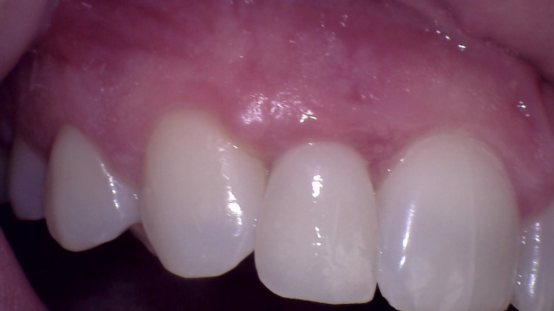 After Dental Implant