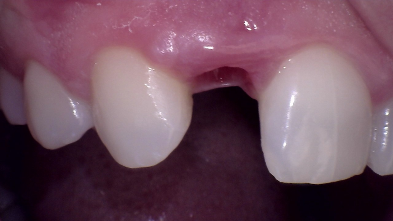 Before Dental Implant