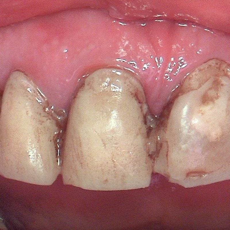 Before porcelain veneers treatment