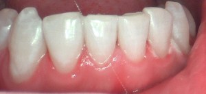 patient's teeth after teeth whitening