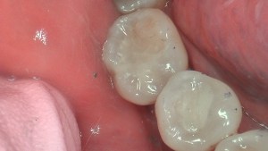 tooth colored fillings