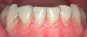 patient's teeth before teeth whitening