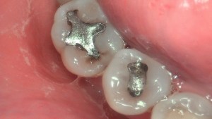 silver tooth fillings