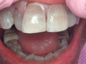 After whitening and bonding fractued tooth