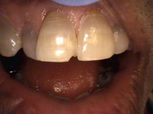 Before whitening and bonding